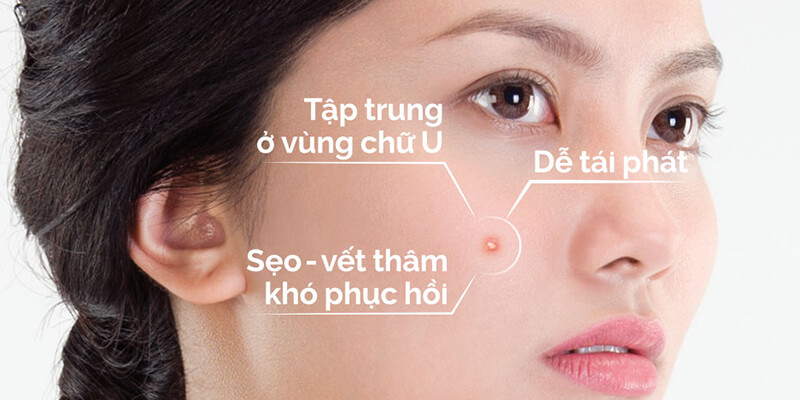 Cách điều trị mụn ở tuổi trưởng thành