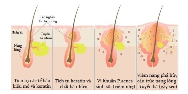 Tiết lộ 4 cách trị mụn bọc hiệu quả đơn giản tại nhà