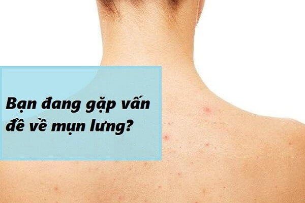 Lý do khiến mụn lưng mọc ngày càng nhiều và tái trở lại thường xuyên